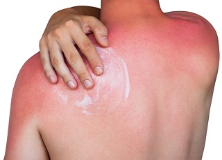 Smörj dig med after sun efter en dag i solen